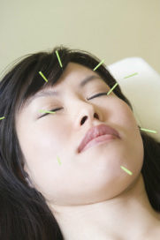 Woman getting facial acupuncture